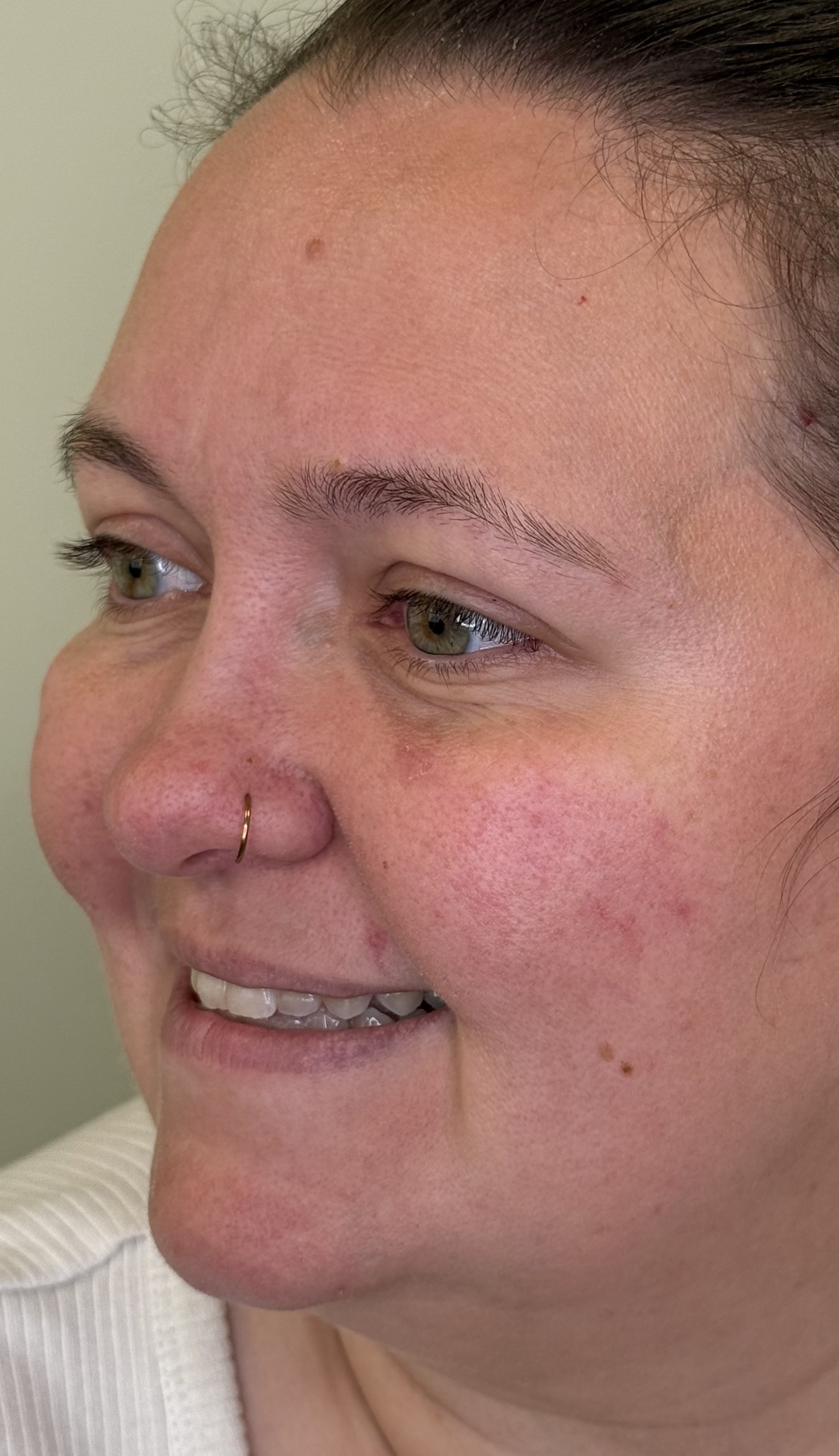 After anti-wrinkle injections — crow's feet softened