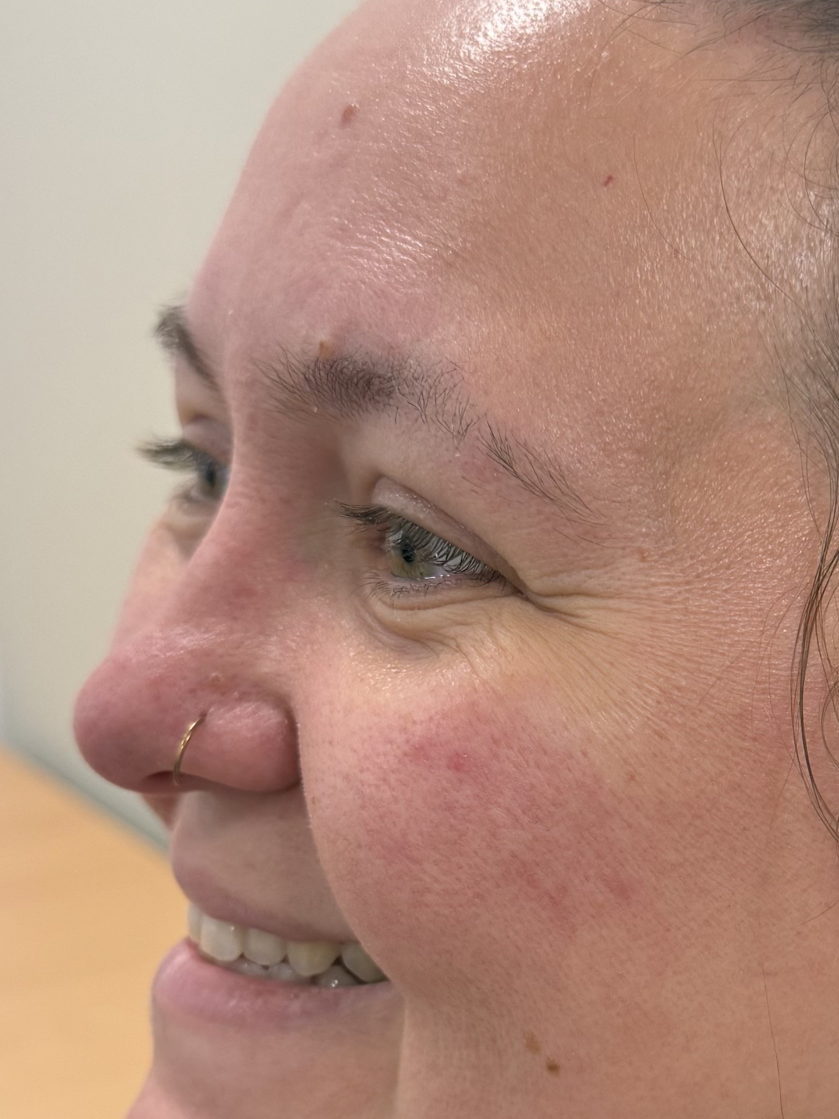 Before anti-wrinkle injections — crow's feet visible when smiling