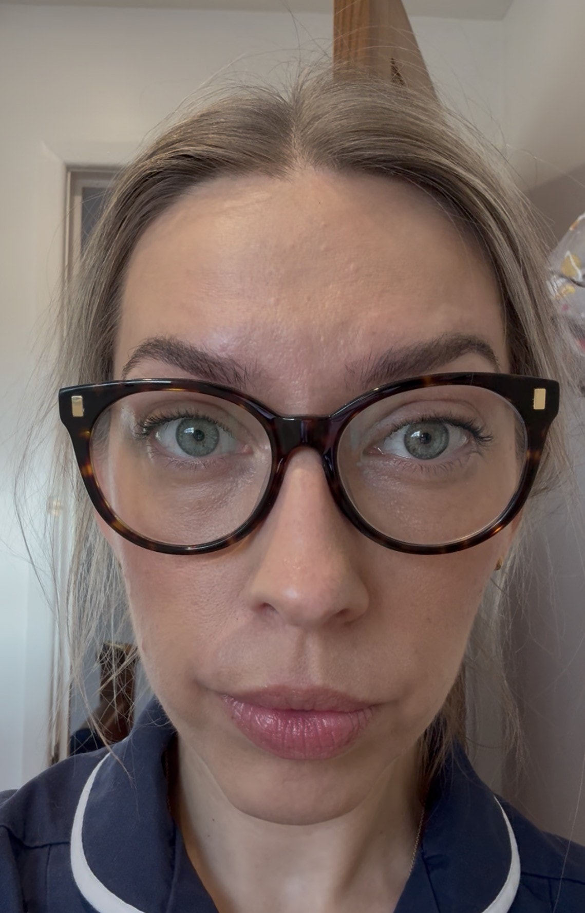 After anti-wrinkle injections — forehead and frown lines smoothed