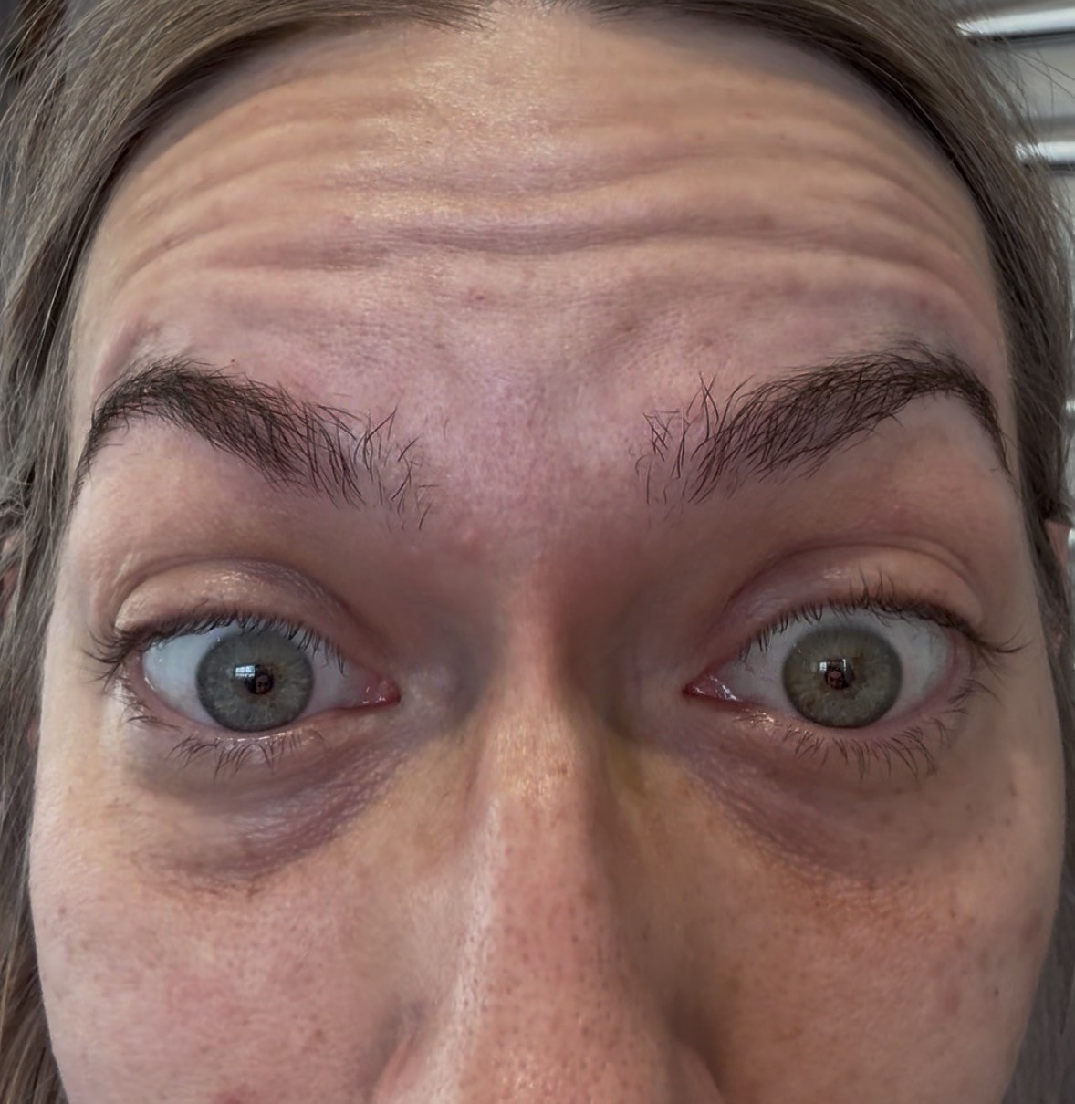 Before anti-wrinkle injections — forehead lines and frown lines visible