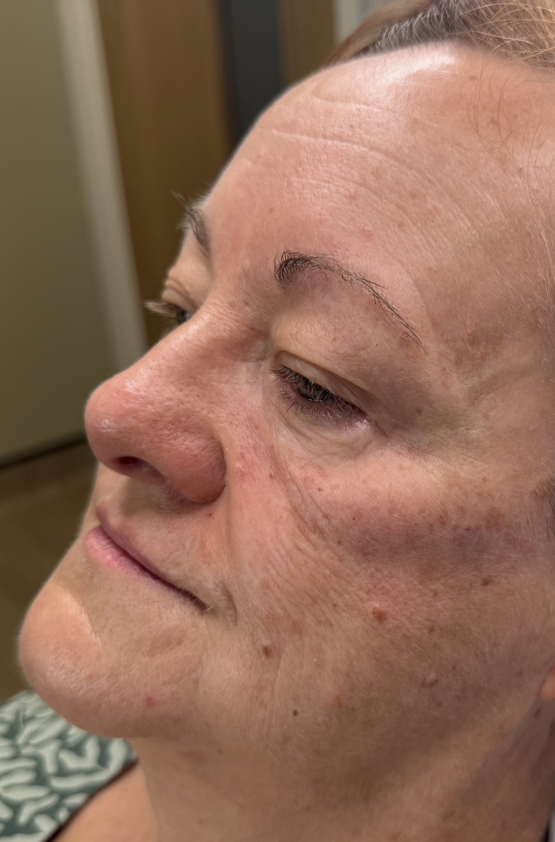 After cheek filler — lifted and contoured
