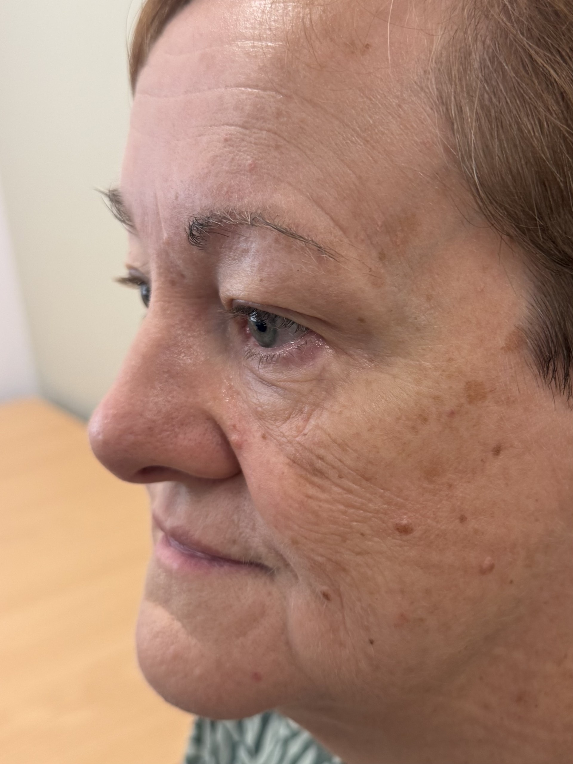 Before cheek filler treatment