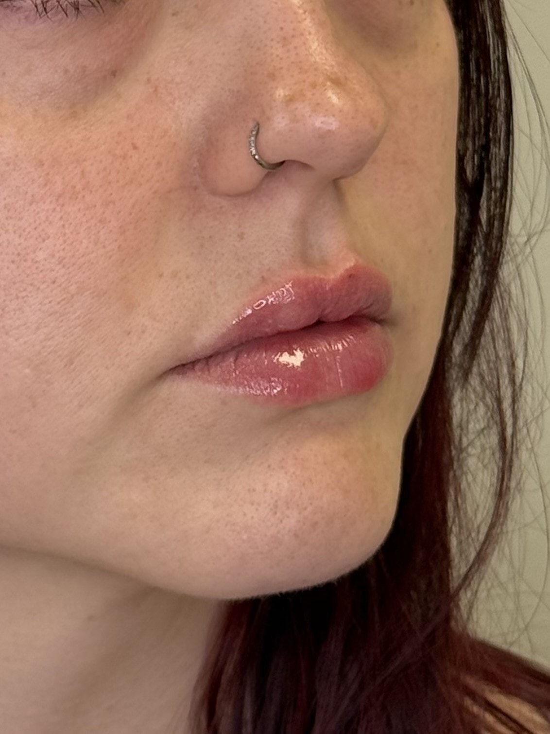 After lip filler — natural volume and definition