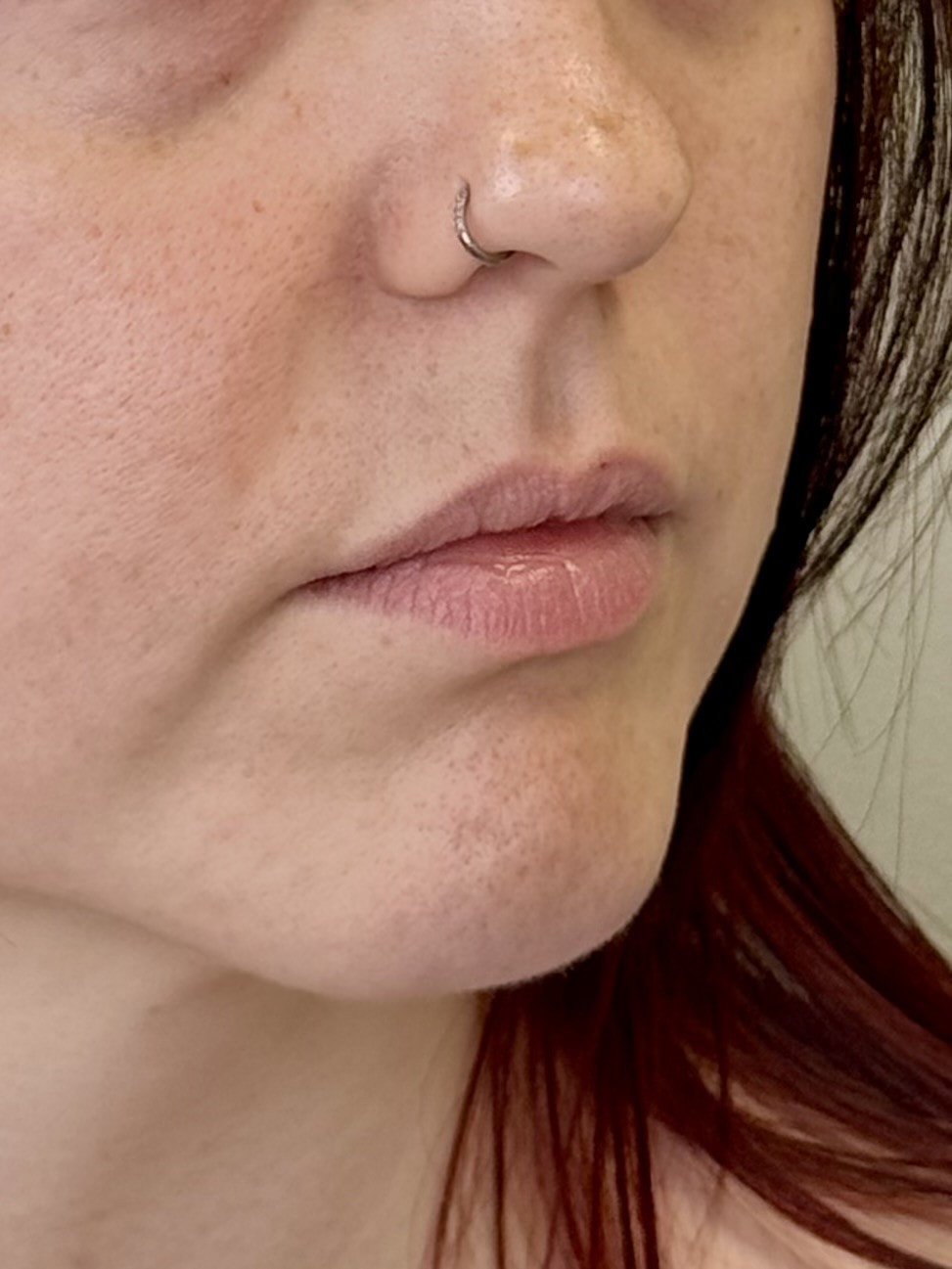 Before lip filler treatment