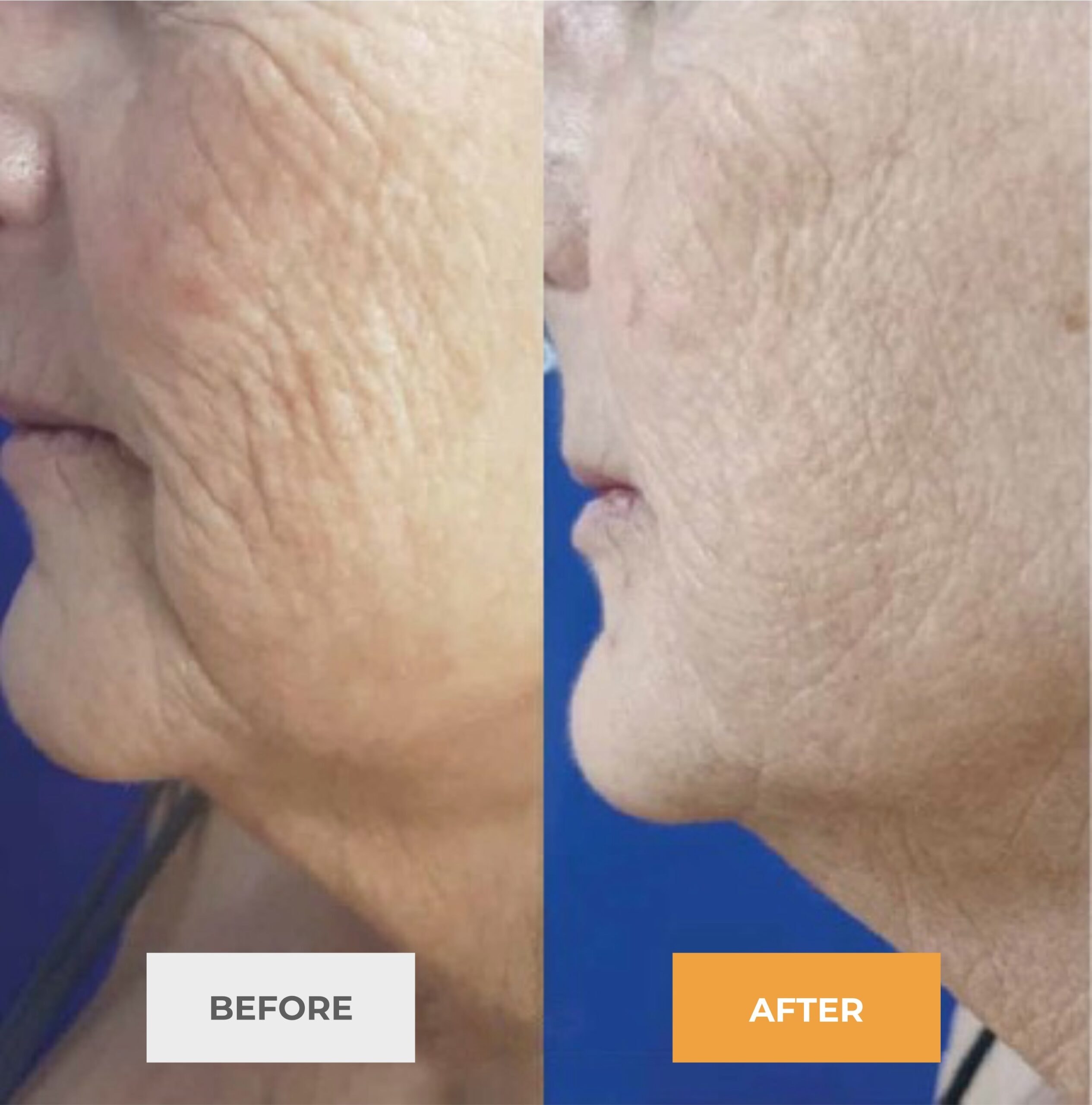 Before microneedling with exosomes — jaw and neck skin laxity and fine lines