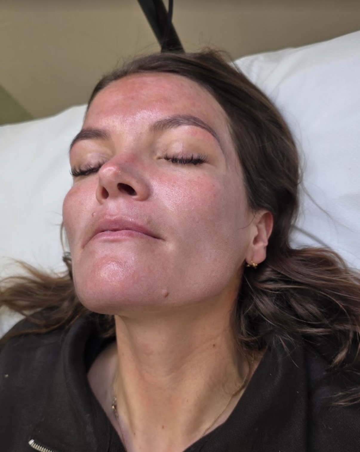 After microneedling — immediate post-treatment result
