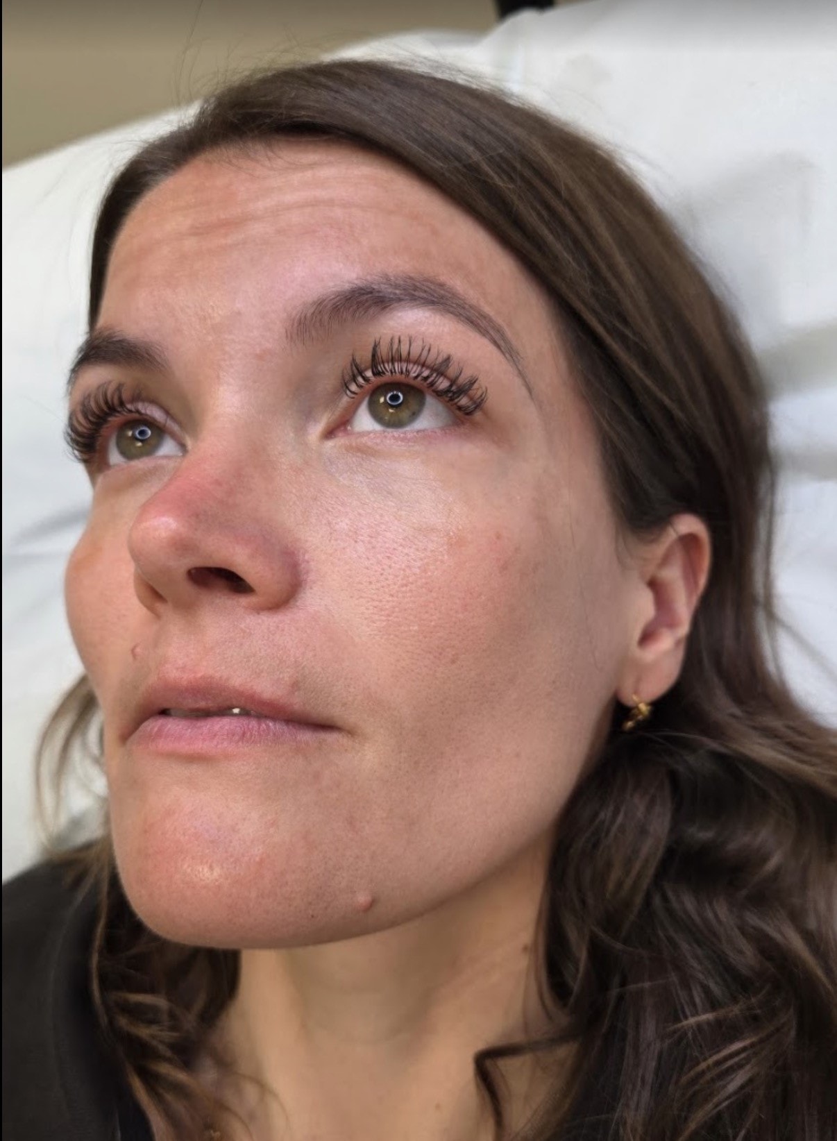 Before microneedling — skin texture prior to treatment